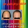 فروش پروتز ترمیم مو چسب وریموور