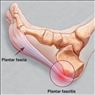 درمان قطعی خار پاشنه فقط با جلسه درمان